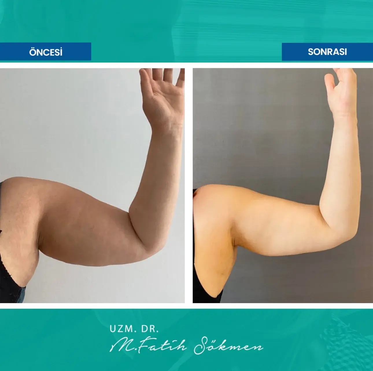 Samsun Basen İnceltme before after öncesi sonrası karşılaştırma