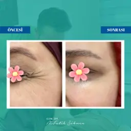 Samsun botoks öncesi sonrası — vaka 3 — onaylı klinik vaka görseli