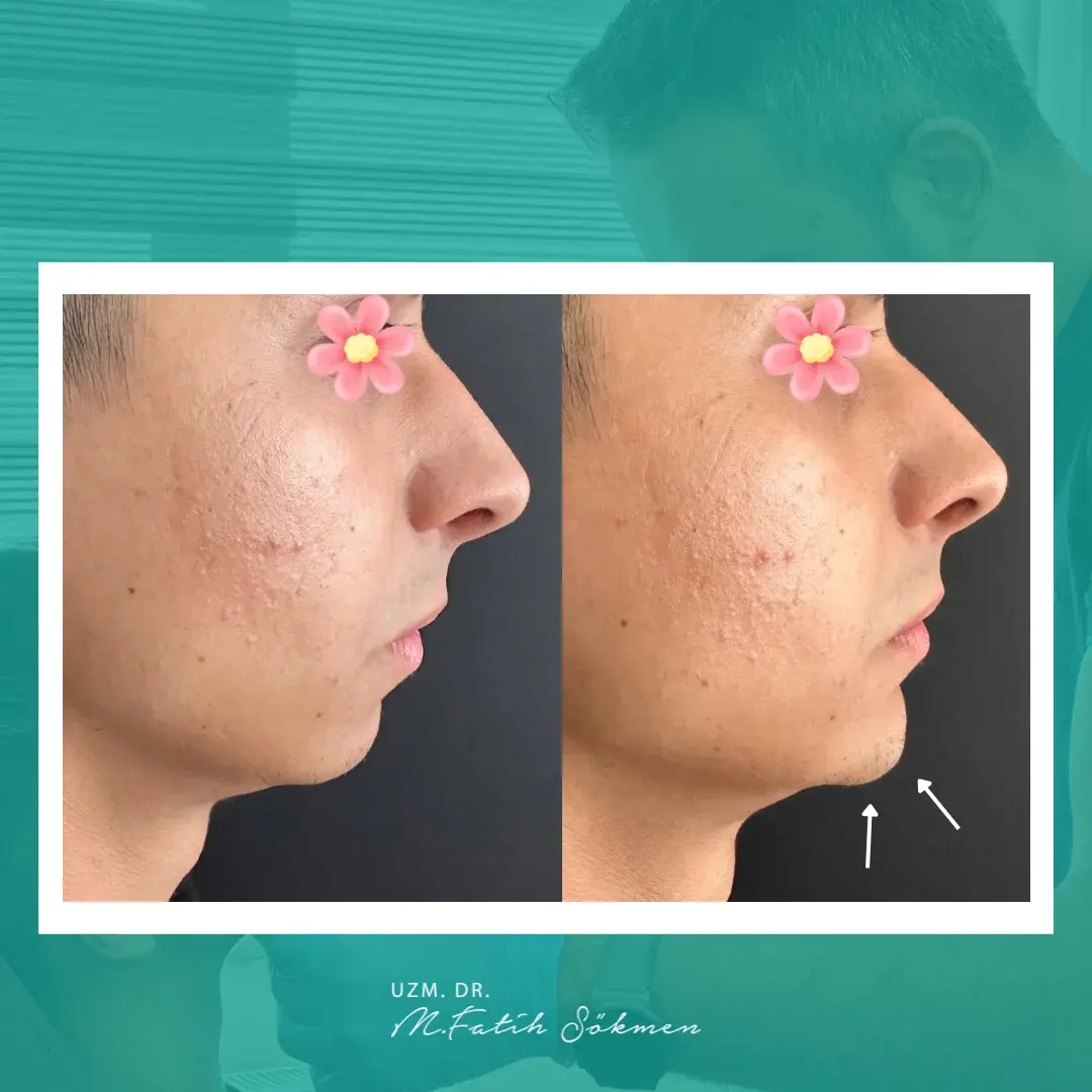 Samsun Çene Dolgusu before after öncesi sonrası karşılaştırma