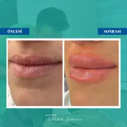 Samsun dudak dolgusu öncesi sonrası — vaka 1 — hyalüronik asit dolgu sonucu