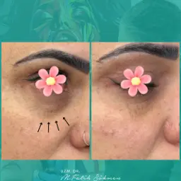 Samsun Göz Altı Tedavisi before after öncesi sonrası karşılaştırma — vaka 2