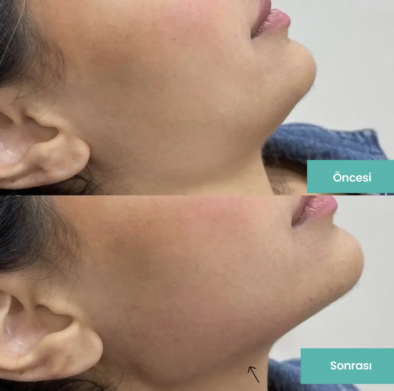 Samsun Jawline Dolgusu before after öncesi sonrası karşılaştırma