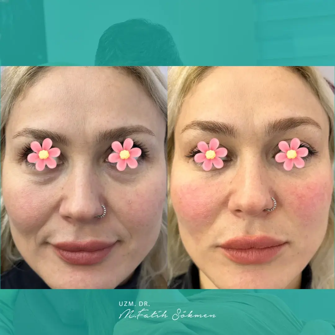 Samsun Kombine Gençleştirme before after öncesi sonrası karşılaştırma