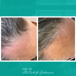 Samsun Saç Tedavisi before after öncesi sonrası karşılaştırma — vaka 2