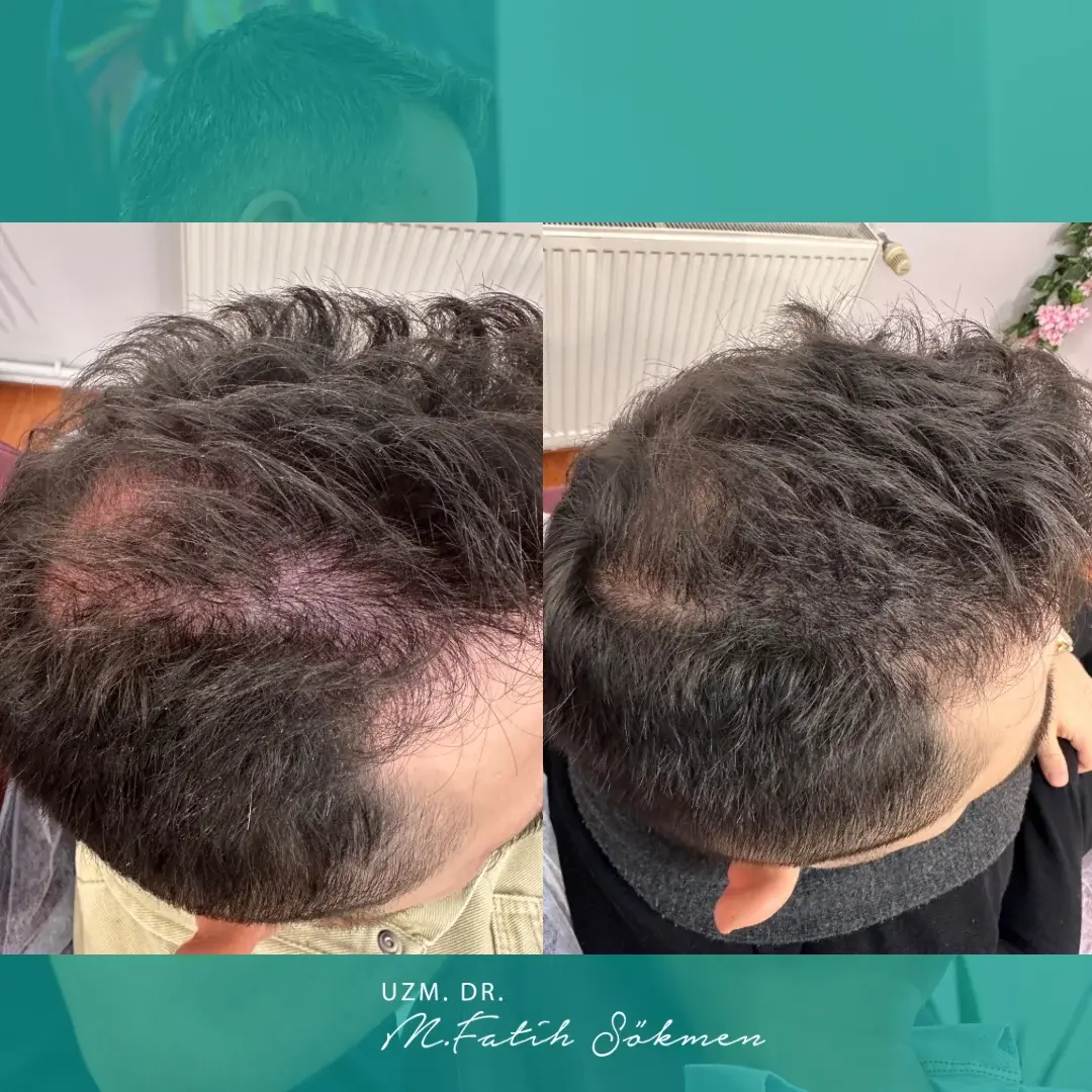Samsun Saç Mezoterapisi before after öncesi sonrası karşılaştırma