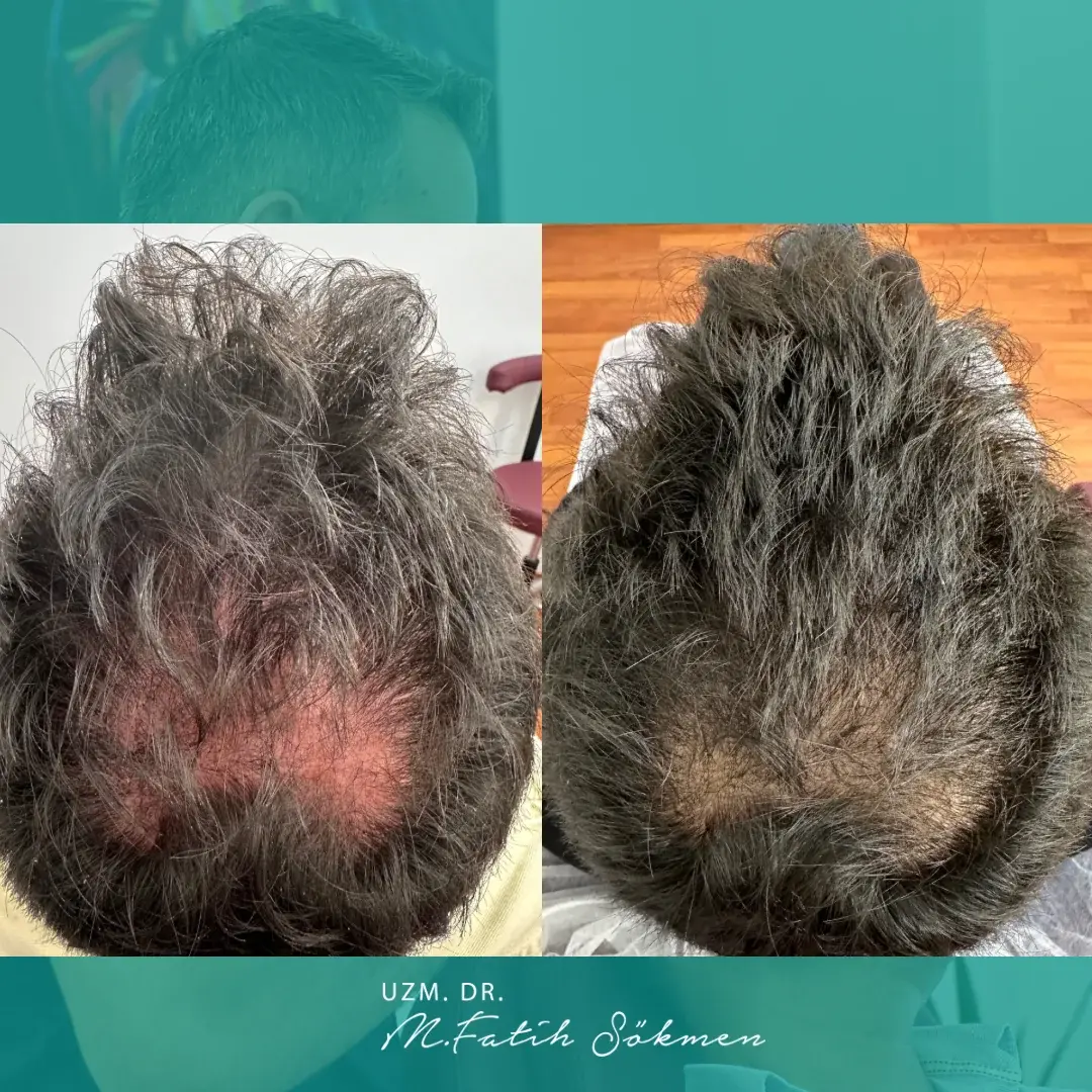Samsun Saç PRP before after öncesi sonrası karşılaştırma