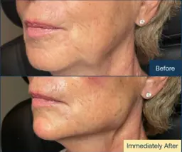 Samsun Sıvı Yüz Germe before after öncesi sonrası karşılaştırma — vaka 2