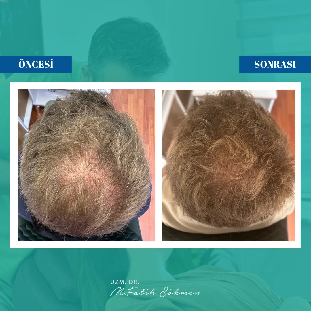 Samsun Saç Tedavisi before after öncesi sonrası karşılaştırma — vaka 1