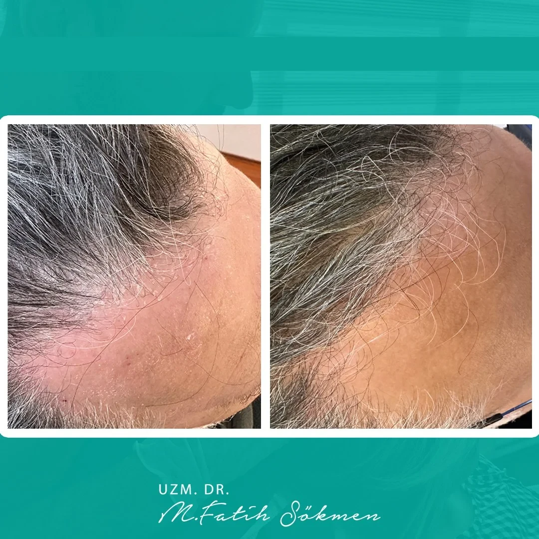 Samsun Saç Tedavisi before after öncesi sonrası karşılaştırma — vaka 2