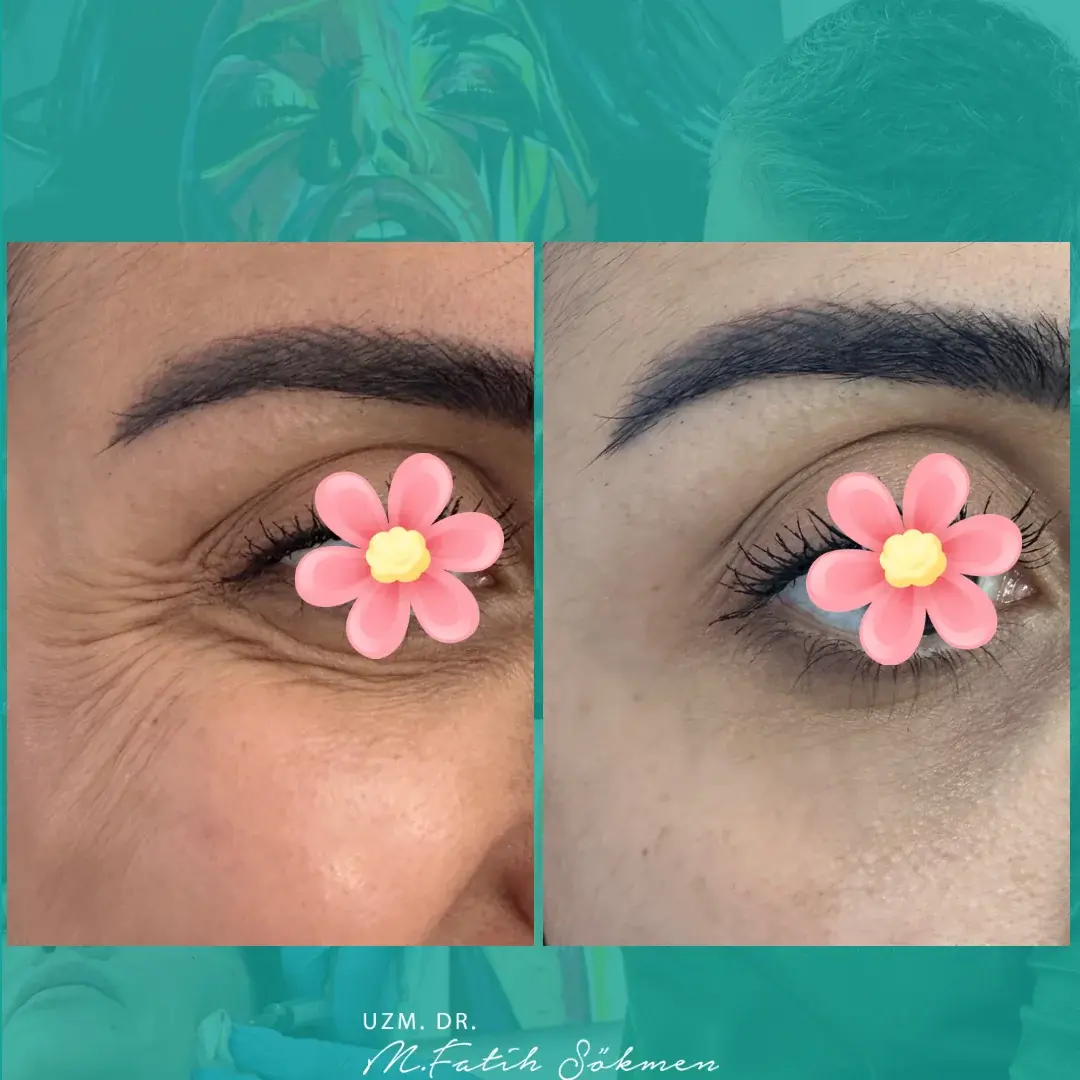 Samsun Göz Çevresi (Kazayağı) before after Samsun Göz Çevresi (Kazayağı) before after öncesi sonrası karşılaştırma