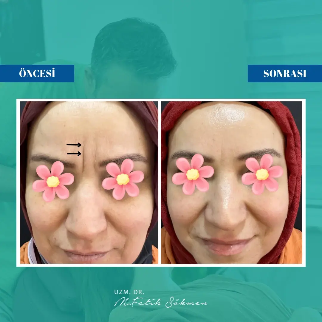 Samsun kaş arası botoksu öncesi sonrası Samsun kaş arası botoksu öncesi sonrası — onaylı klinik vaka görseli