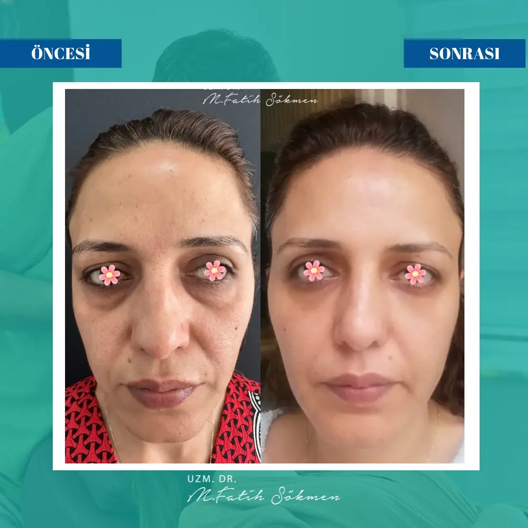 Samsun Yüz Kontür Restorasyonu before after Samsun Yüz Kontür Restorasyonu before after öncesi sonrası karşılaştırma